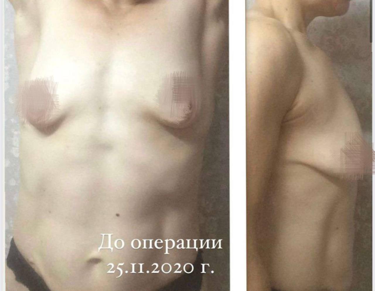 Некроз и асимметрия груди: жительница Краснодара требует 10 млн рублей с клиники в Уфе за последствия пластики