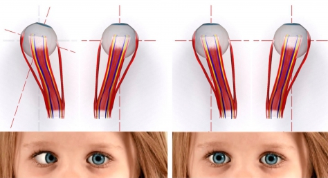 Косоглазие у детей: до и после