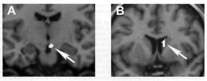 Снимок мозга, сделанный Хелен Фишер и ее коллегами. На нем видна активность в области ВОП (A) и хвостатого ядра (B) | Источник: Fisher, Helen. Aron, Arthur. Brown, Lucy L. «Romantic Love: An fMRI Study of a Neural Mechanism for Mate Choice.» The Journal of Comparative Neurology, 2005