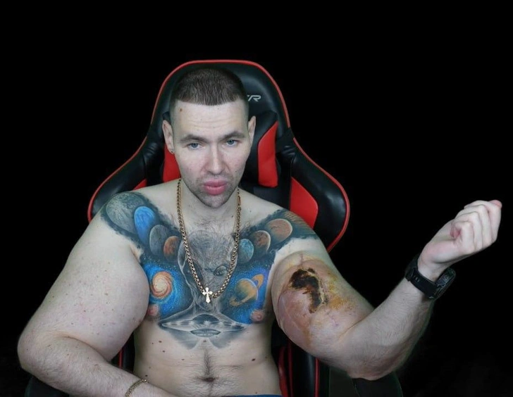 Блогер Руки-Базуки может лишиться конечностей: Кириллу Терешину грозит ампутация | maximonline.ru