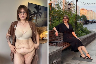 Yugra Woman Who Lost 80 kg Shows Skin