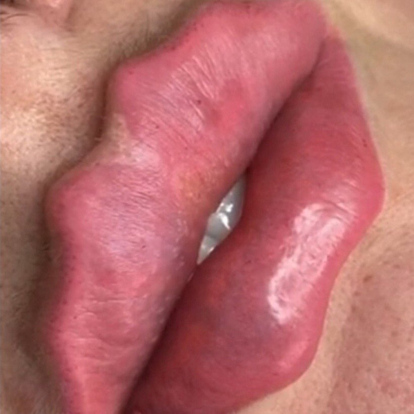 Фото №4 - Как «губы дьявола» стали самой обсуждаемой бьюти-методикой и почему косметологи не решаются о ней говорить
