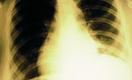 ВОЗ: 9 млн человек заразились туберкулезом за год