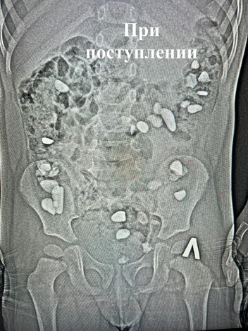 Трехлетний мальчик проглотил камни в Ессентуках | Источник: Минздрав Ставропольского края