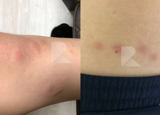 В рязанском кинотеатре девушку и молодого человека покусали клопы | ya62.ru