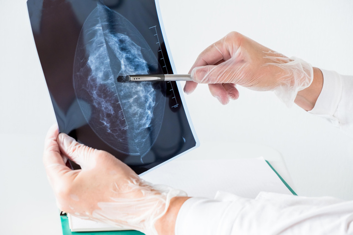 29-летней женщине отказали в маммографии — позже ей диагностировали рак 4 степени