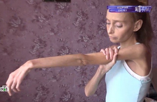 «Состояние критическое, в шаге от смерти»: 26-летняя Розалина из Татарстана весит 29 кило из-за диет