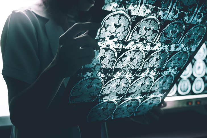 Они у нас в голове: обнаружены новые виновники болезни Альцгеймера