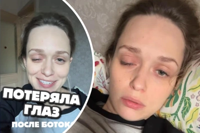 Москвичка заплатила 50 тысяч за ботокс от мигрени и осталась без глаза