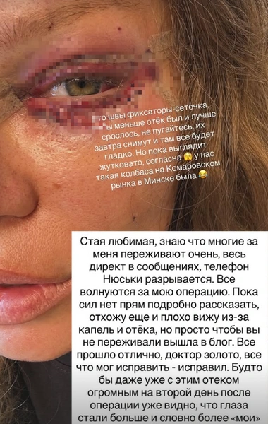 Рита призналась подписчикам, что на днях перенесла еще одну пластику, дабы исправить ошибки прошлого хирурга