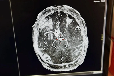 Energy Drinks Linked to Stroke, Riazan Man Saved