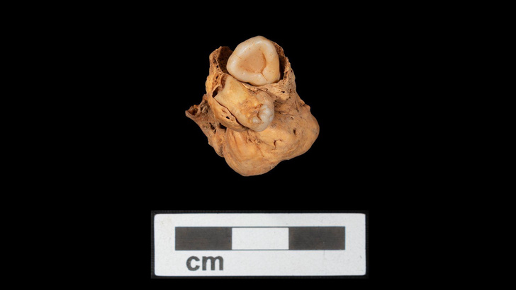 3000-летняя опухоль с зубами: в Египте нашли останки девушки c тератомой