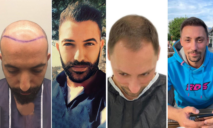 Пересадка волос до и после у мужчин реальные фото