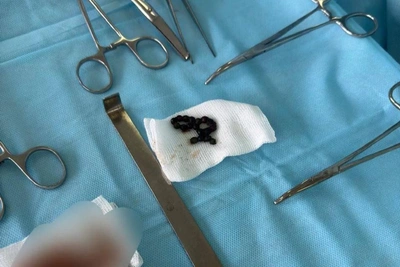 Doctors Remove 18 Magnets from Three-Year-Old's Intestine in Stavropol