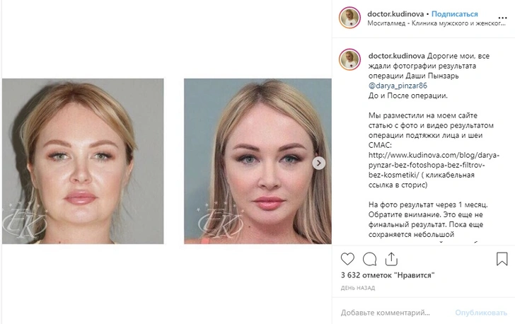 Дарья Пынзарь до и после пластической операции | woman.ru