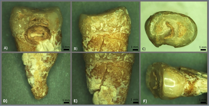 Верхний премоляр монахини. На изображении (A) видна дыра, образовавшаяся из-за кариеса между цементом и эмалью; (B) — (F) — различные срезы одного и того же образца зуба. Масштаб на всех изображениях — 1 мм | Источник: Journal of Archaeological Science: Reports