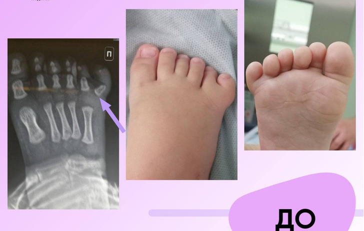 В Подмосковье врачи прооперировали малыша с шестью пальцами на ноге