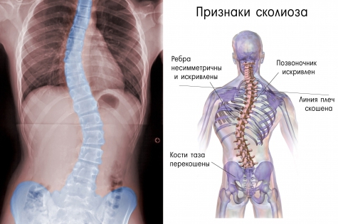 Признаки сколиоза у детей