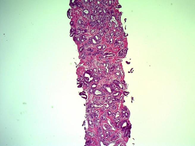 Часть предстательной железы, пораженная раком | Источник: Новосибирская областная больница