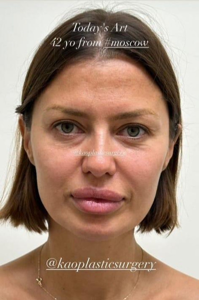 Надоели морщины и мешки под глазами: пластический хирург Беллы Хадид сделает Виктории Боне новое лицо