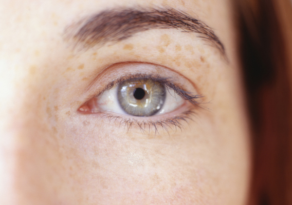 Удаление веснушек | WOMAN