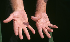 Ученые выяснили, что у мужчин с короткими пальцами больше шансов умереть от коронавируса