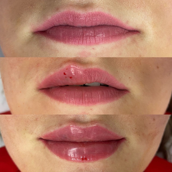 реальные фото женщин до и после увеличения губ