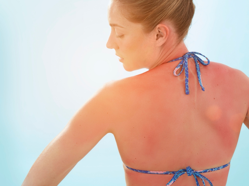 Аллергия на солнце: что это такое, и как защитить кожу | marieclaire.ru