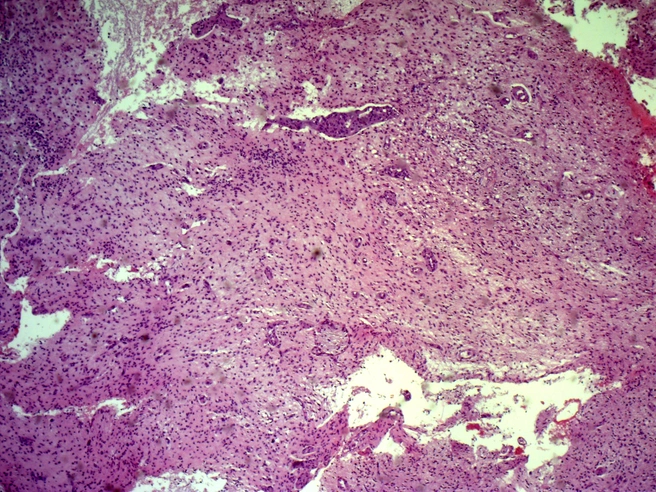 Анапластическая астроцитома головного мозга выглядит как рваное облачко над здоровыми клетками | Источник: Новосибирская областная больница