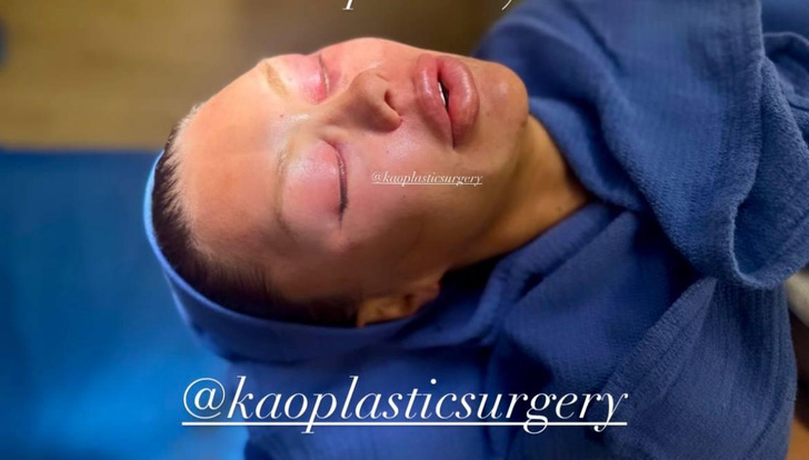 Пластический хирург опубликовал фото Бони после операции — на снимок больно смотреть