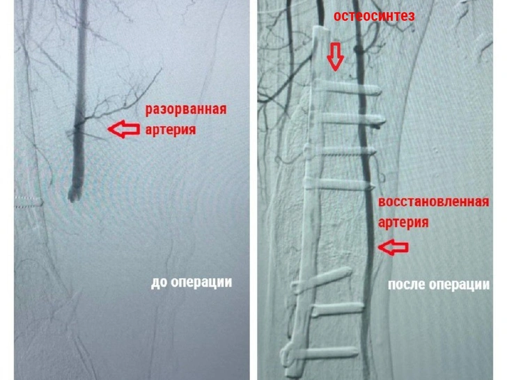 Просто поскользнулся на улице: врачи спасли мужчину, едва не погибшего от потери 2 литров крови