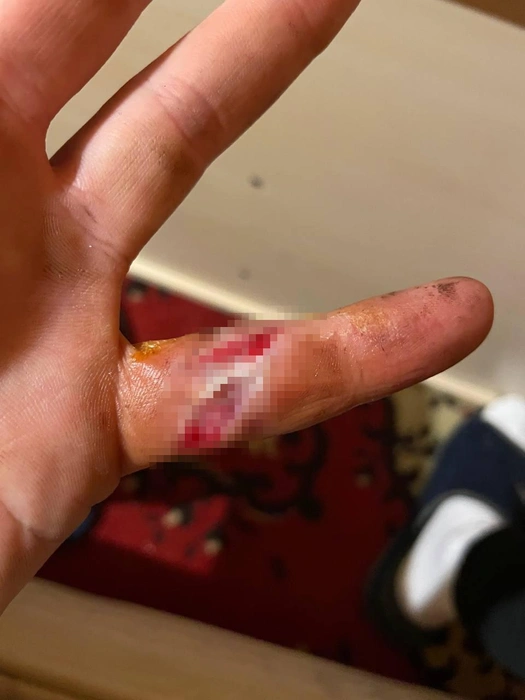 Порез на пальце оказался очень глубоким | Источник: Василий Савочкин