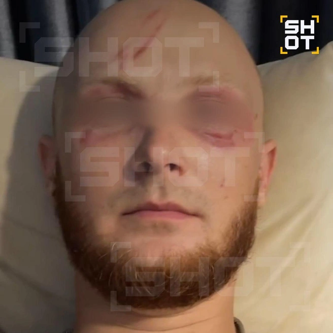 Россиянин получил сильные повреждения век | Источник: SHOT / Telegram