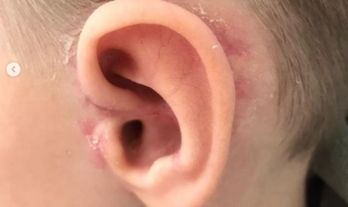 В Кемерово врачи пришили ребенку оторванное ухо: как прошла необычная операция