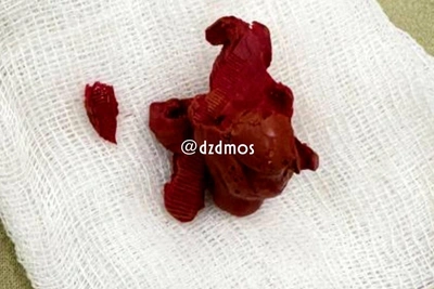 Пластилин удалили из мочевого пузыря подростка