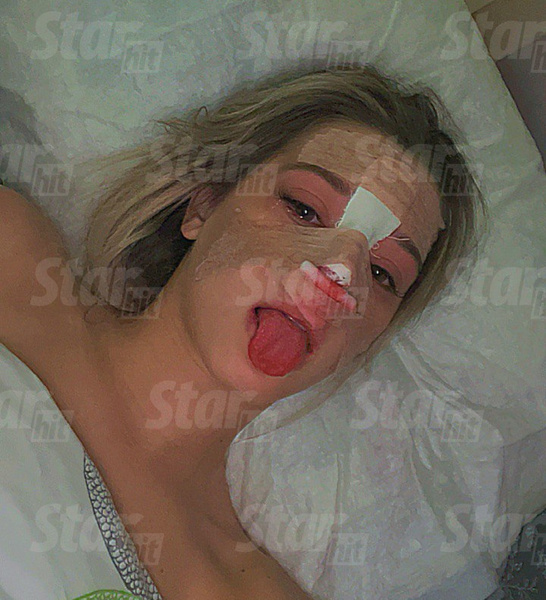 «Очень больно!» Девушка Дани Милохина, тиктокерша Юля Гаврилина сделала ринопластику – фото