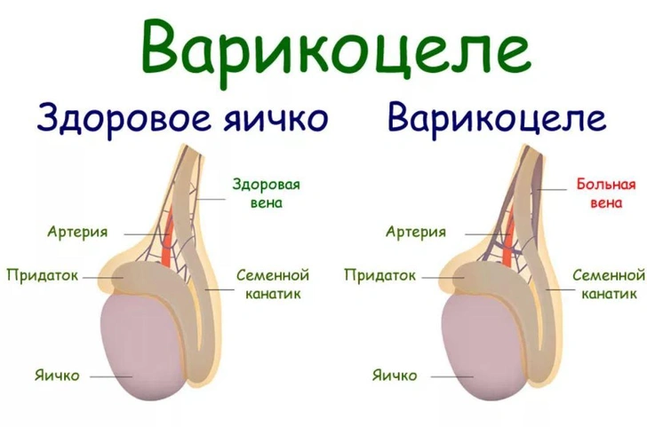 Варикоцеле: болезнь, которая делает мужчину бесплодным