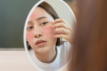 «Приливы кельтов»: что такое розацеа и как избежать ее развития