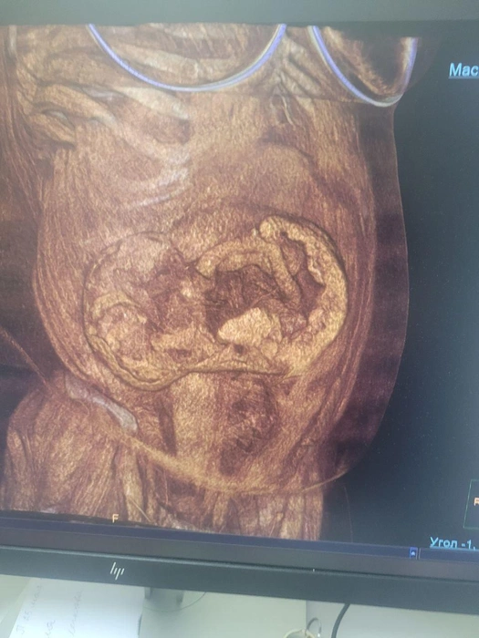 Спайки затронули большую часть кишечника женщины | Источник: t.me/dzvo36