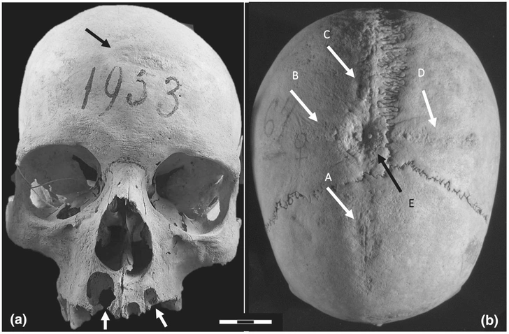 При жизни дважды вскрыли череп: жуткая история находки из некрополя лангобардов