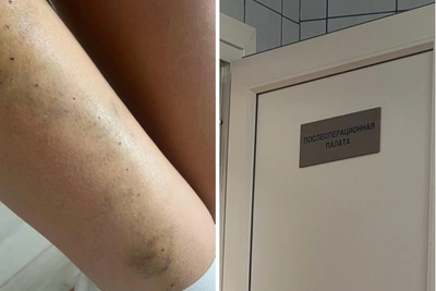 Как сделать операцию по варикозу бесплатно по ОМС в Мурманске