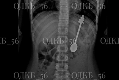 В Оренбургской области ребенок проглотил ложку длиной 14 см
