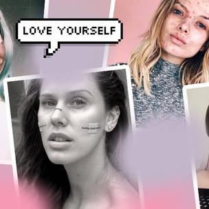 5 блогеров с проблемной кожей, которые поднимут твою самооценку