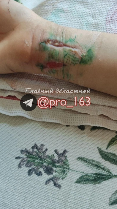 В одной из больниц автограда школьнику наложили швы | Источник: «ЧП ТОЛЬЯТТИ | РЕГИОН 63» / t.me