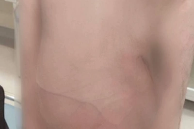 Giant Hernia Operated on at Dzhanelidze Institute