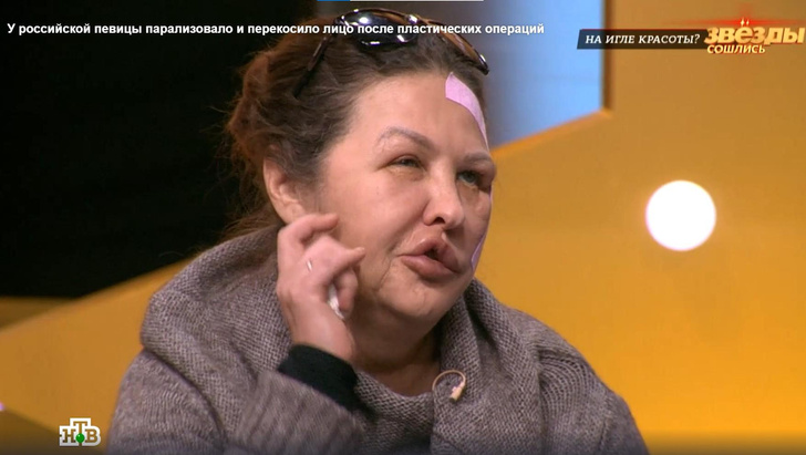 Пластический хирург изуродовал певицу Елену Демидову — она не спит и все время прячет лицо