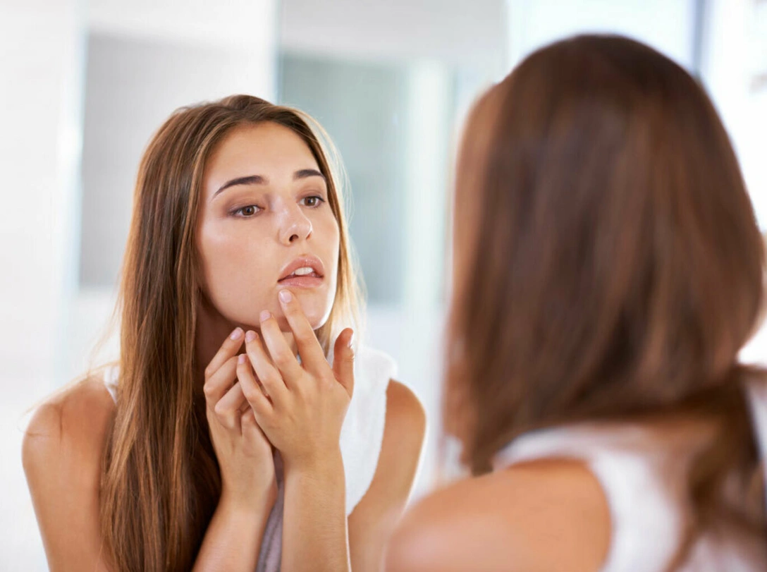 Конец истории: как победить прыщи раз и навсегда | marieclaire.ru