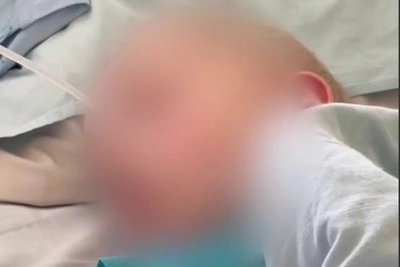 Toddler in Yekaterinburg develops brain inflammation after chickenpox