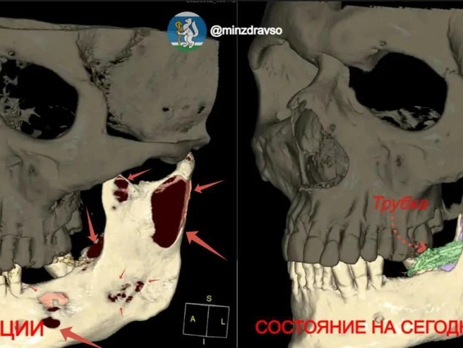 Челюсть удалось сохранить благодаря малоинвазивной операции | Источник: Здоровье уральцев | Минздрав Свердловской области