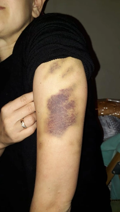 Синяки на теле Любови Покровской